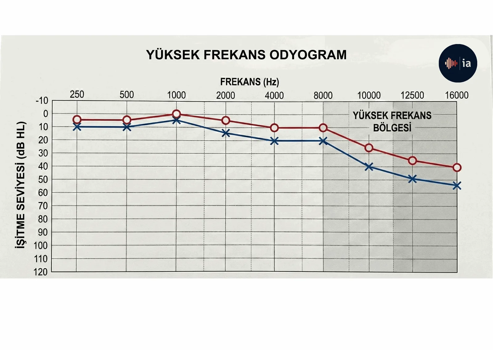 Example of a high-frequency audiogram