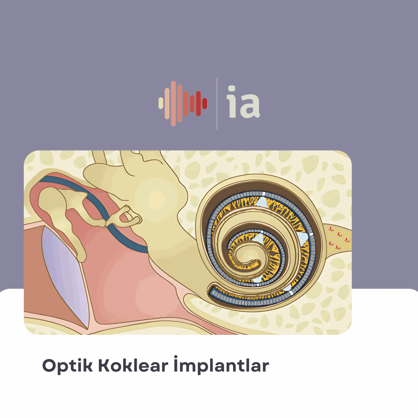 Optical Cochlear Implants: A Revolution in Hearing Technology