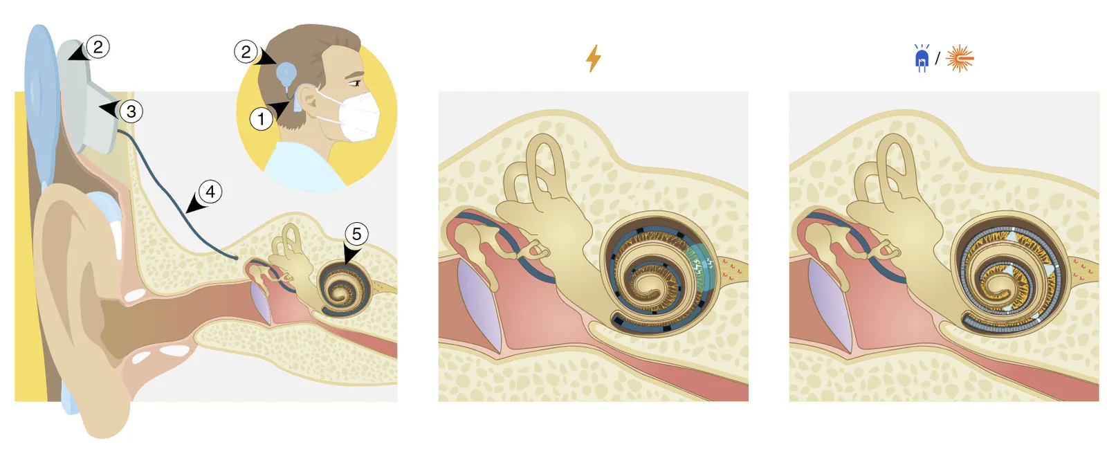 Working principle of the optical cochlear implant